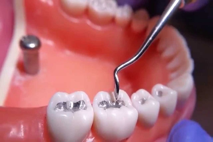 Dental Amalgams