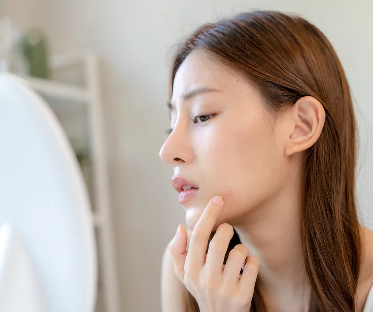 Acne Scars